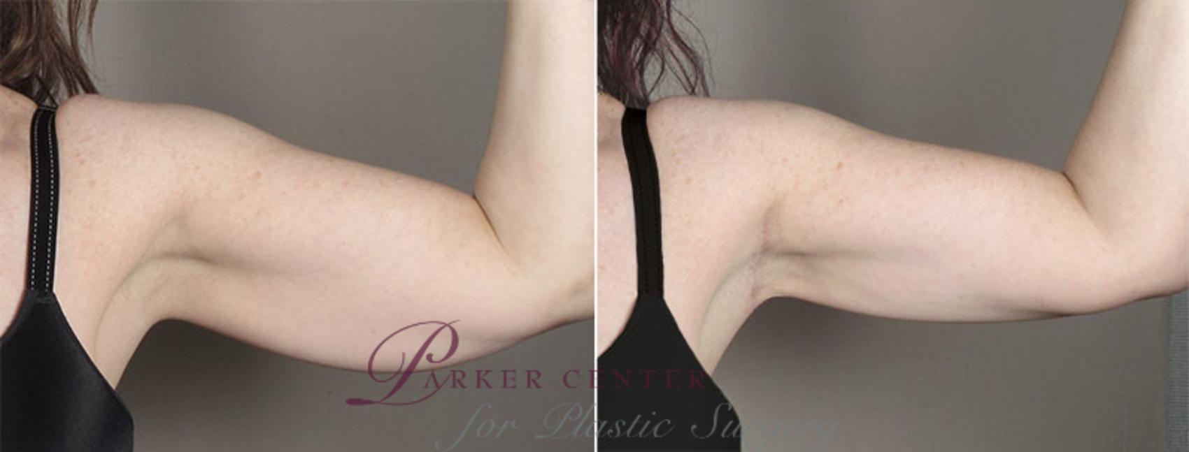 Upper Arm Rejuvenation Case 831 Before & After View #2 | Paramus, NJ | Parker Center for Plastic Surgery