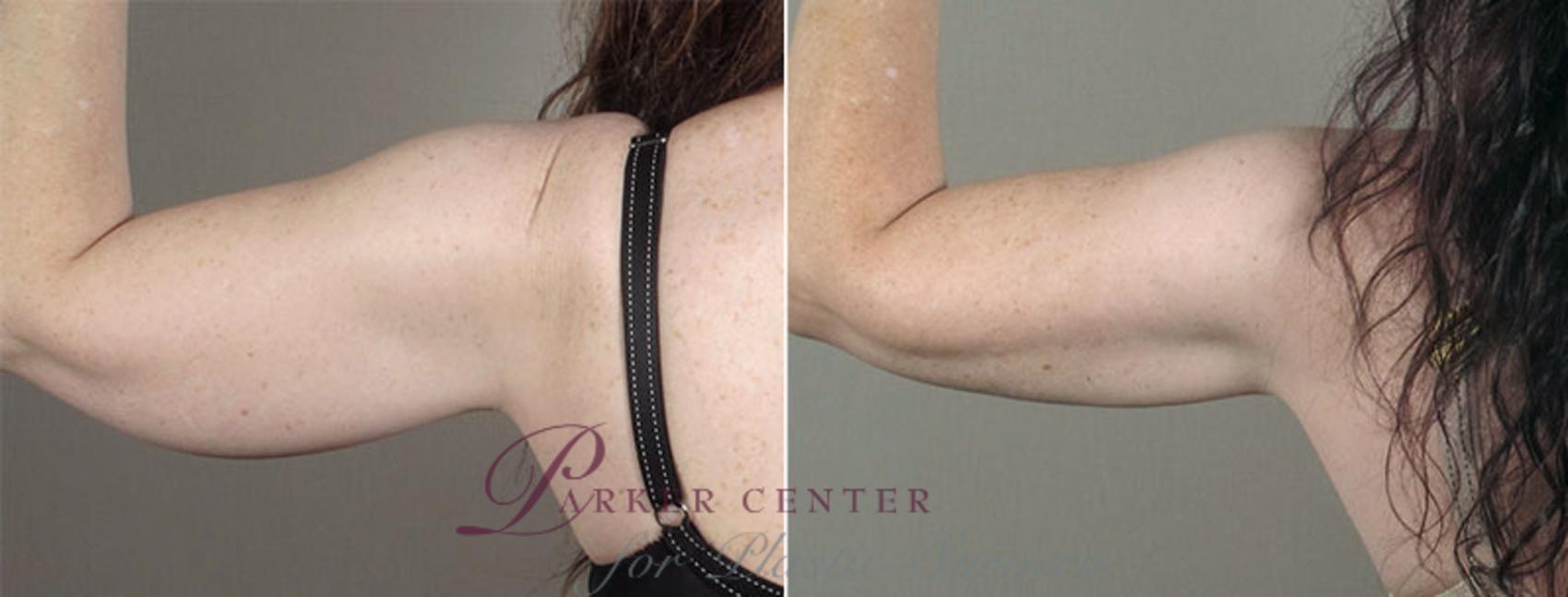 Upper Arm Rejuvenation Case 831 Before & After View #3 | Paramus, NJ | Parker Center for Plastic Surgery