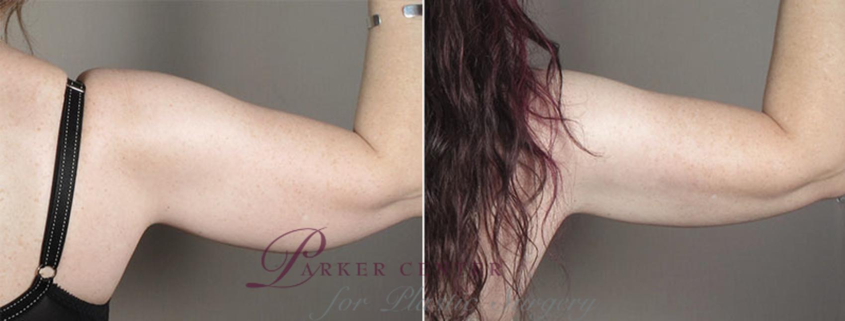 Upper Arm Rejuvenation Case 831 Before & After View #4 | Paramus, NJ | Parker Center for Plastic Surgery