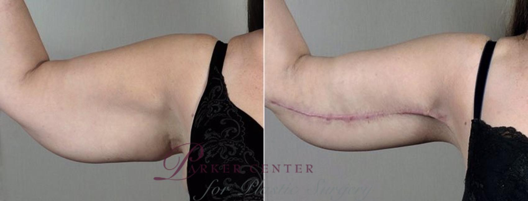 Upper Arm Rejuvenation Case 832 Before & After View #1 | Paramus, NJ | Parker Center for Plastic Surgery