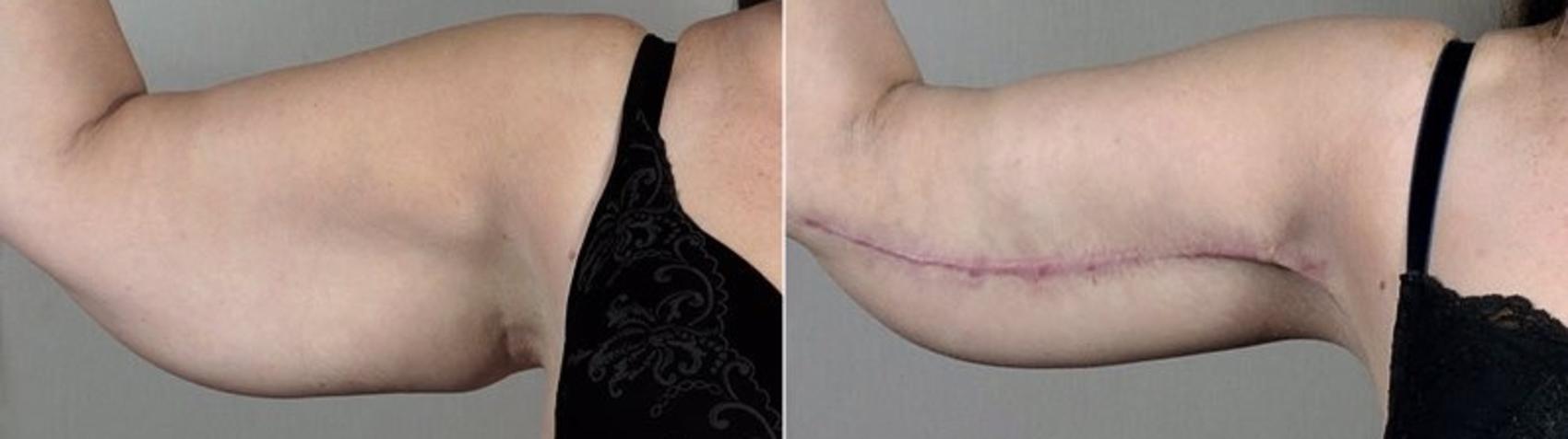 Upper Arm Rejuvenation Case 832 Before & After View #1 | Paramus, New Jersey | Parker Center for Plastic Surgery