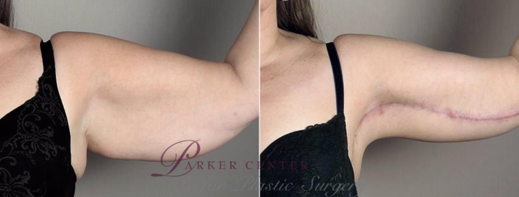 Upper Arm Rejuvenation Case 832 Before & After View #2 | Paramus, NJ | Parker Center for Plastic Surgery