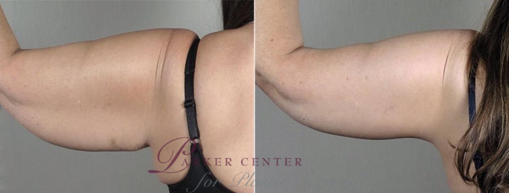 Upper Arm Rejuvenation Case 832 Before & After View #3 | Paramus, NJ | Parker Center for Plastic Surgery
