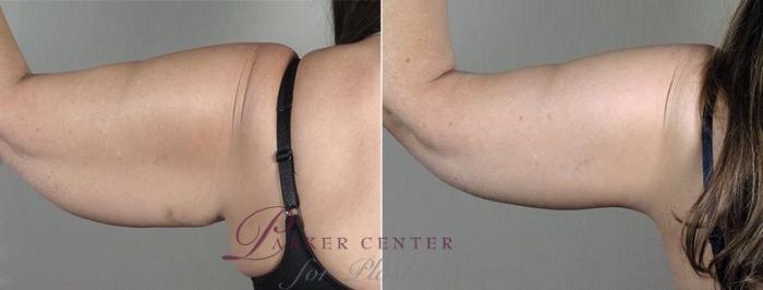 Upper Arm Rejuvenation Case 832 Before & After View #3 | Paramus, NJ | Parker Center for Plastic Surgery