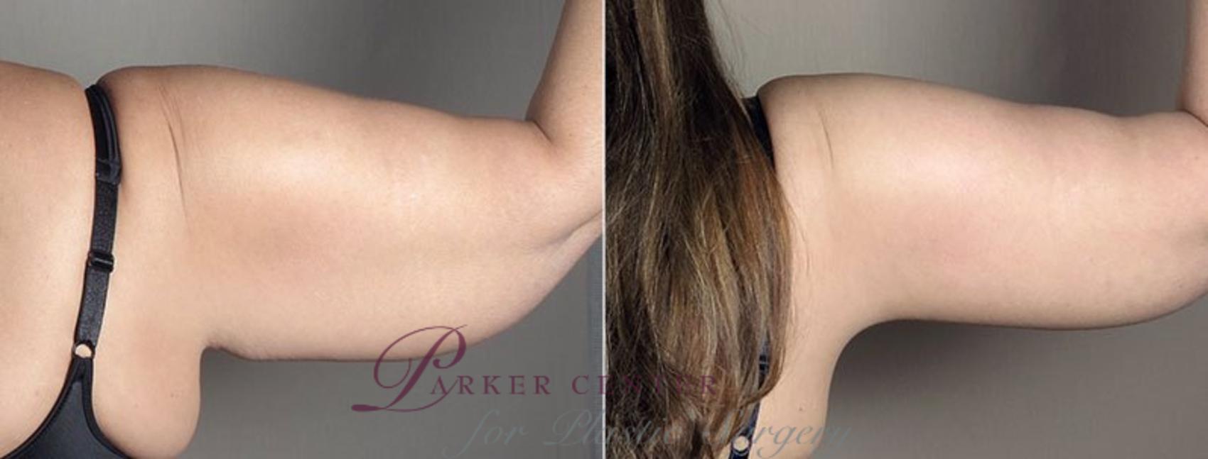 Upper Arm Rejuvenation Case 832 Before & After View #4 | Paramus, NJ | Parker Center for Plastic Surgery