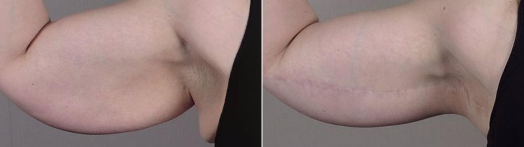 Upper Arm Rejuvenation Case 833 Before & After View #1 | Paramus, NJ | Parker Center for Plastic Surgery