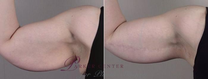 Upper Arm Rejuvenation Case 833 Before & After View #1 | Paramus, NJ | Parker Center for Plastic Surgery