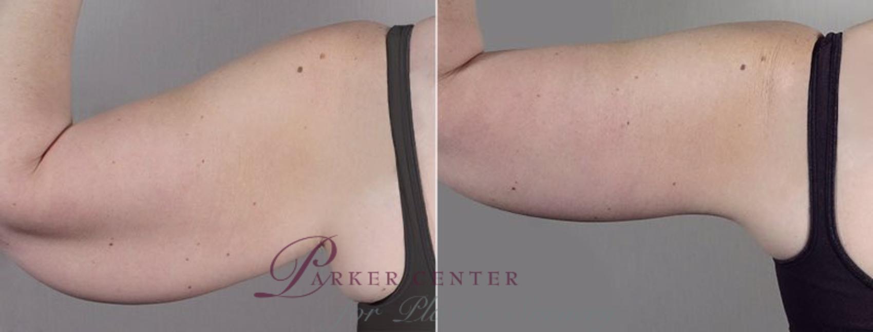Upper Arm Rejuvenation Case 833 Before & After View #3 | Paramus, NJ | Parker Center for Plastic Surgery