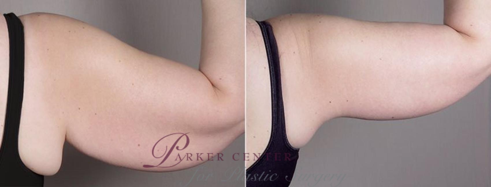 Upper Arm Rejuvenation Case 833 Before & After View #4 | Paramus, NJ | Parker Center for Plastic Surgery