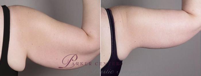 Upper Arm Rejuvenation Case 833 Before & After View #4 | Paramus, NJ | Parker Center for Plastic Surgery