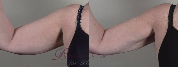 Upper Arm Rejuvenation Case 834 Before & After View #1 | Paramus, NJ | Parker Center for Plastic Surgery