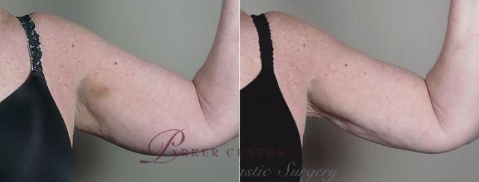 Upper Arm Rejuvenation Case 834 Before & After View #2 | Paramus, NJ | Parker Center for Plastic Surgery