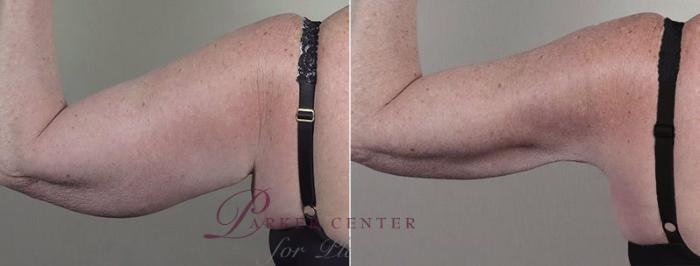 Upper Arm Rejuvenation Case 834 Before & After View #3 | Paramus, NJ | Parker Center for Plastic Surgery