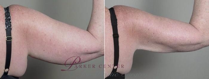 Upper Arm Rejuvenation Case 834 Before & After View #4 | Paramus, NJ | Parker Center for Plastic Surgery