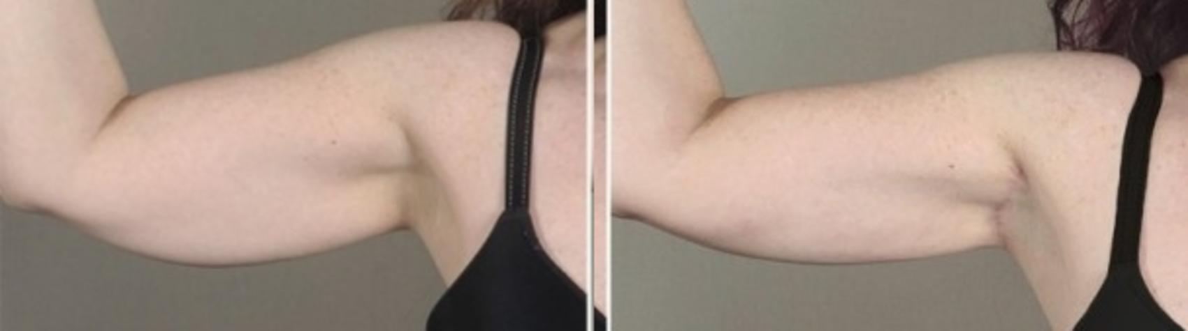 Upper Arm Rejuvenation Case 933 Before & After View #5 | Paramus, New Jersey | Parker Center for Plastic Surgery