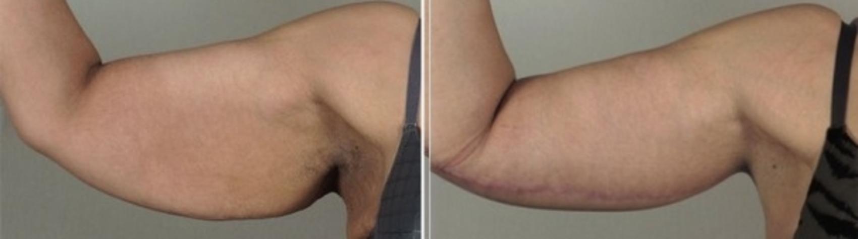 Upper Arm Rejuvenation Case 934 Before & After View #5 | Paramus, New Jersey | Parker Center for Plastic Surgery