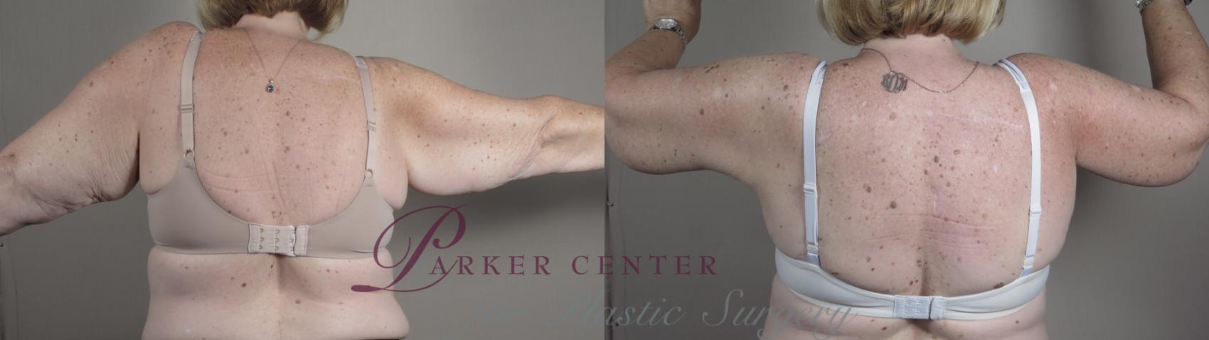 Upper Arm Rejuvenation Case 988 Before & After Back | Paramus, NJ | Parker Center for Plastic Surgery
