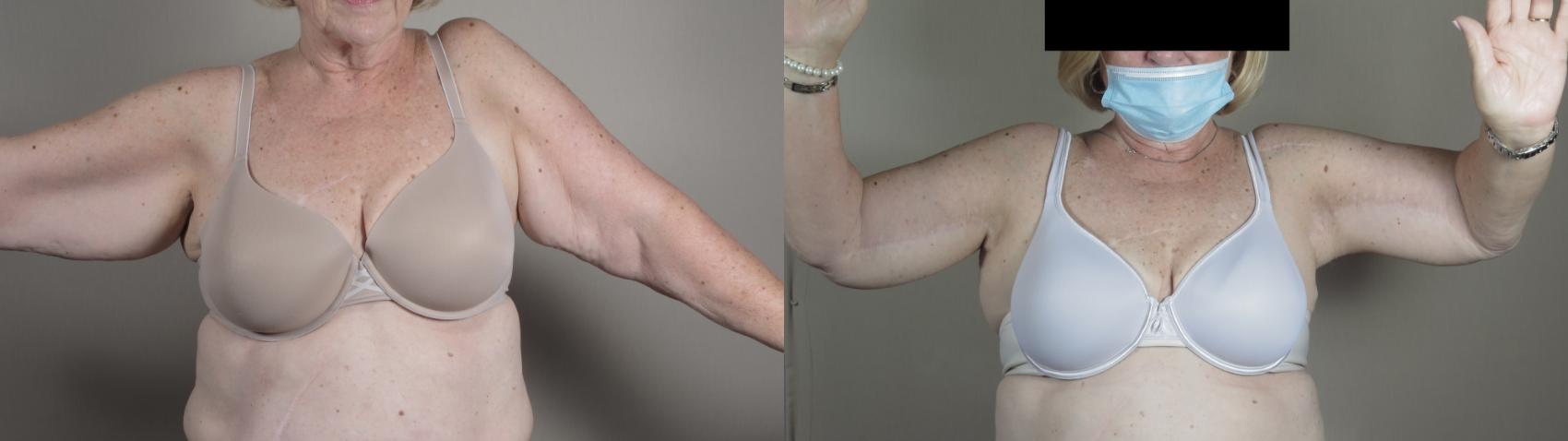 Upper Arm Rejuvenation Case 988 Before & After Front | Paramus, New Jersey | Parker Center for Plastic Surgery