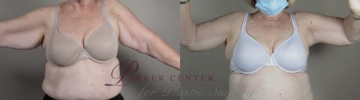 Upper Arm Rejuvenation Case 988 Before & After Front | Paramus, NJ | Parker Center for Plastic Surgery