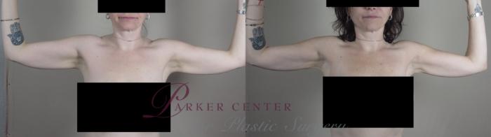 Upper Arm Rejuvenation Case 989 Before & After Front | Paramus, NJ | Parker Center for Plastic Surgery